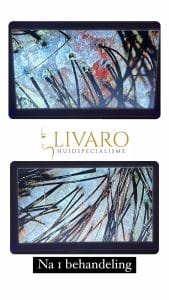 HeadSpa bij Livaro Huidspecialisme in Heeswijk-Dinther.